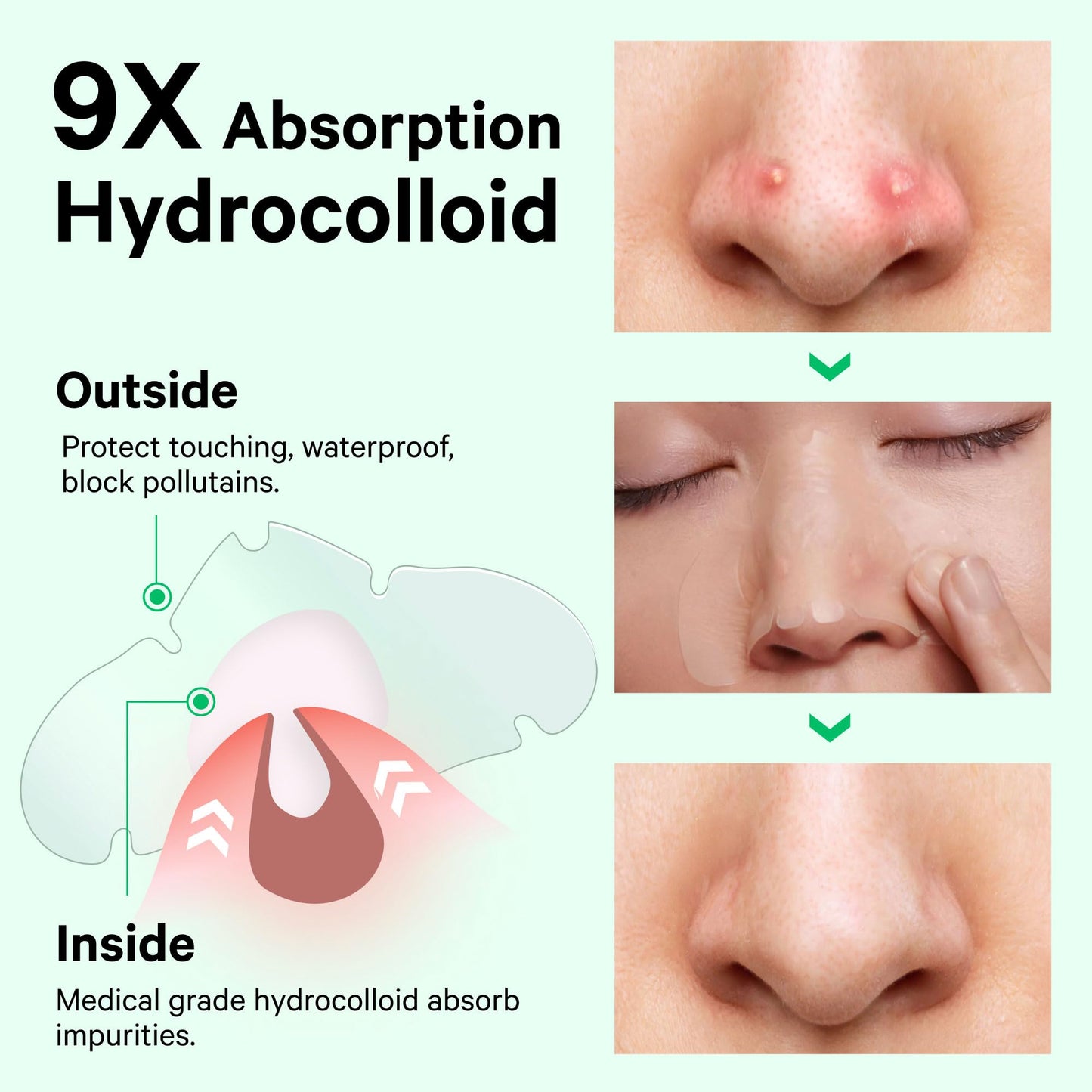 Sosky Hydrocolloid Pimple & Pore Patches for Nose, Absorb Oil Overnight, Target Pimples, Zits and Pores, FSA Eligible Acne Patches, Clear Skin, 14 Count
