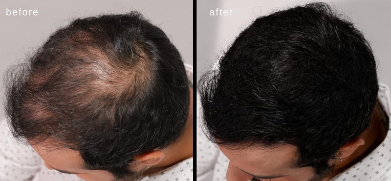 LUXE Hair Building Fibers - Thickening Fibers for Fuller Hair - Hypoallergenic & Dermatologist Tested | Dark Brown, 2-Month Supply