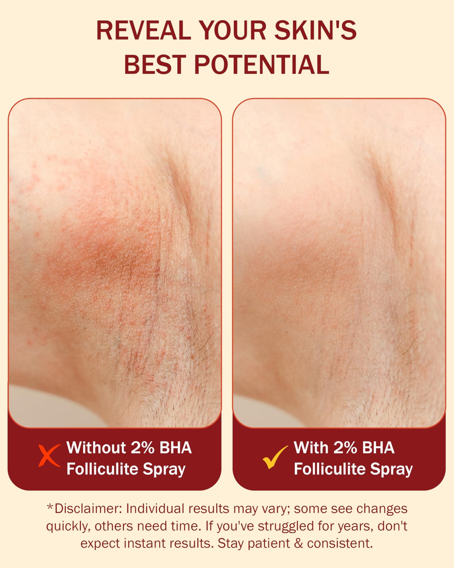 e70 Folliculitis Treatment 2% BHA Body Spray - Salicylic Acid with Tea Tree Oil & Aloe Vera - Spray Moisturizer for Dry Skin, Clogged Pores & Irritation by Made in USA, 4 fl. oz