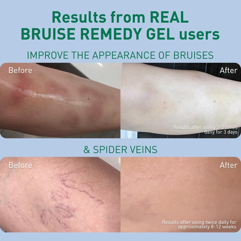 PROcure Arnica & MSM Bruise Remedy Gel – Paraben-Free, Unscented Arnica Montana Gel for Bruising, Spider Veins & Skin Discoloration – 2 Pack