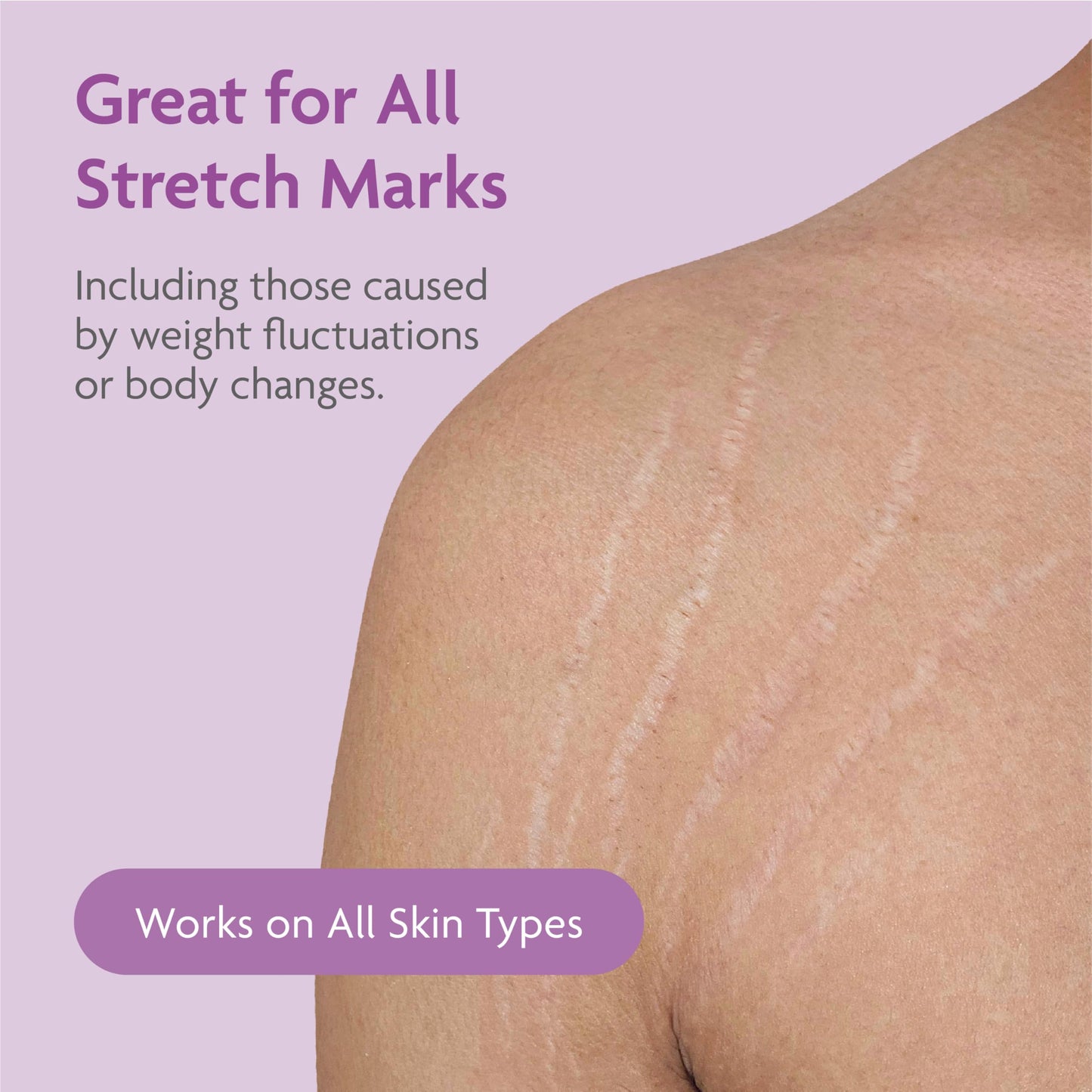 TriLASTIN Stretch Mark Cream – Collagen & Elastin Support Body Cream with Niacinamide, Vitamin C & Vitamin E – Hydrating Stretch Mark Lotion for Belly, Hips & Thighs – Unscented - 5.5 oz
