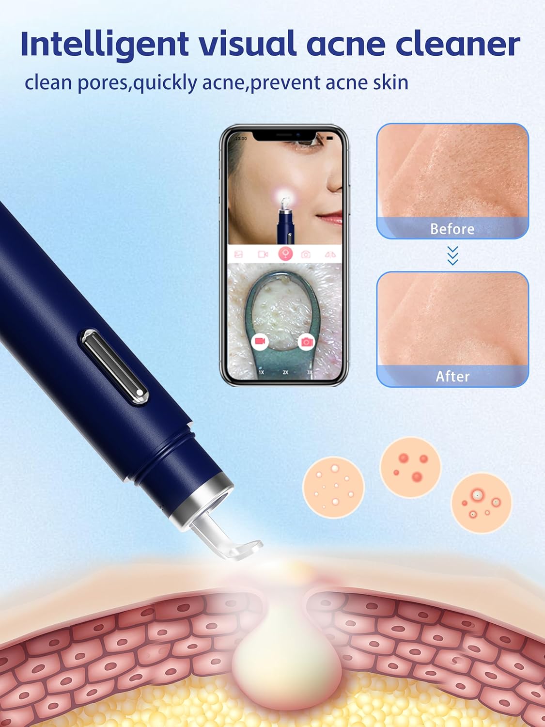 Blackhead Remover Tool Kit with Camera - 20X 1080P Pore Cleaner for iPhone/Android | Blue