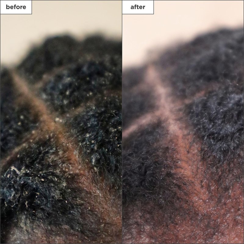 Briogeo Scalp Revival Charcoal + Tea Tree Scalp Treatment | Leave-In Serum for Dry, Flaky, or Itchy Scalp | Hydrating & Balancing | Vegan & Cruelty Free | 1 oz