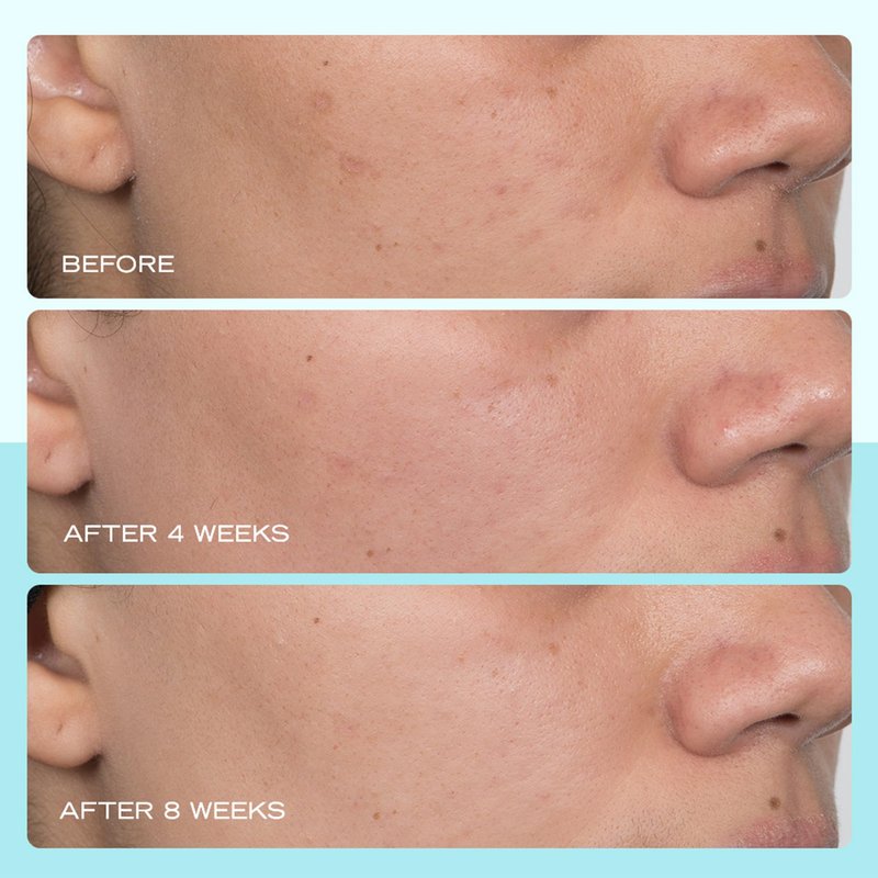 First Aid Beauty - Dark Spot Serum with Niacinamide, Helps Reduce Look of Dark Spots, Sun Spots, Hyperpigmentation, Discoloration & Post-acne marks, Non-Comedogenic, Safe for Sensitive Skin, 1 oz
