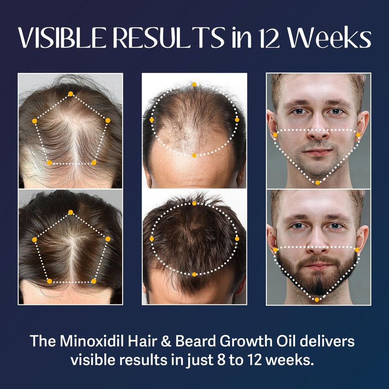 5% Minoxidil for Men Beard Growth Kit: Venanoci Hair Regrowth Oil with Biotin & Rosemary – Thicker, Fuller Beard & Hair – Stop Hair Loss & Thinning – Hair Growth Serum Treatment