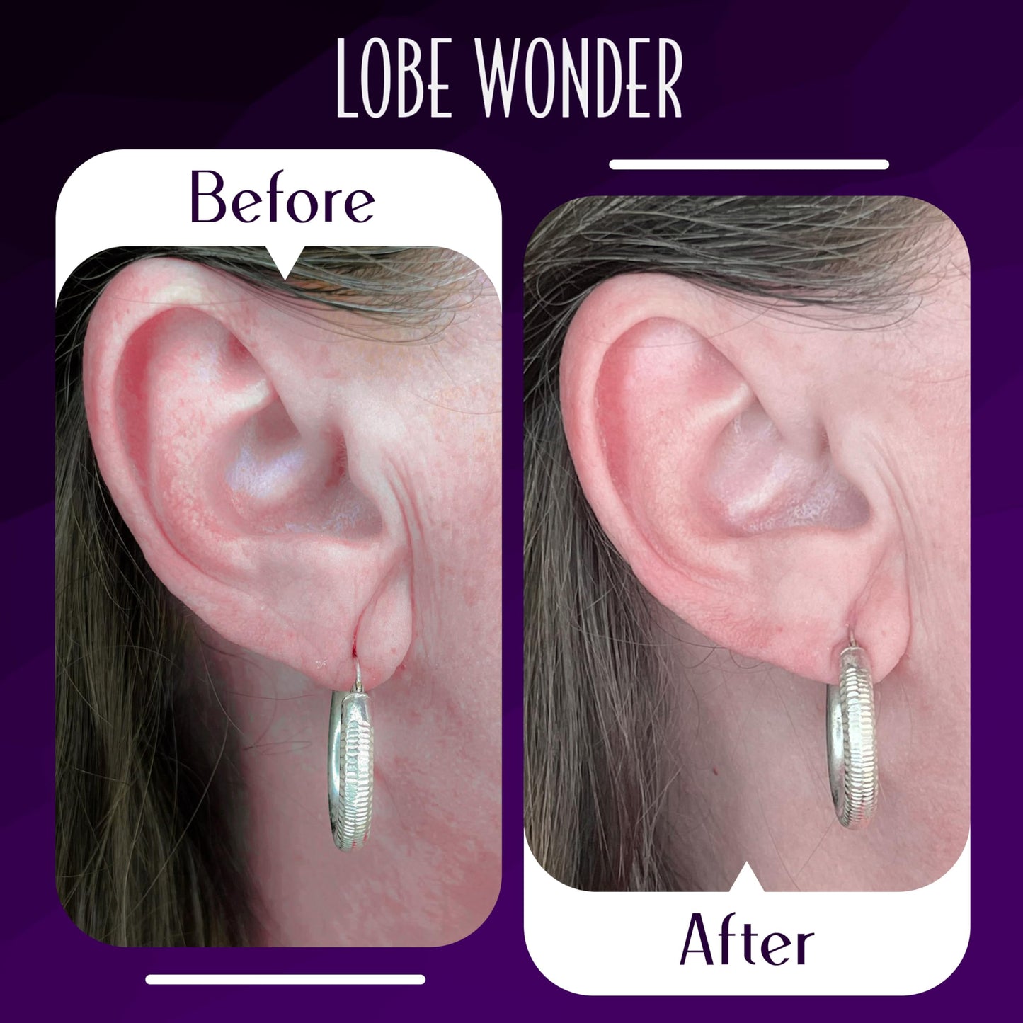 Lobe Wonder - The ORIGINAL Ear Lobe Support Patch for Pierced Ears - Eliminates the Look of Torn or Stretched Piercings - Protects Healthy Ear Lobes from Tearing - 360 Patches - Clear & Latex-Free