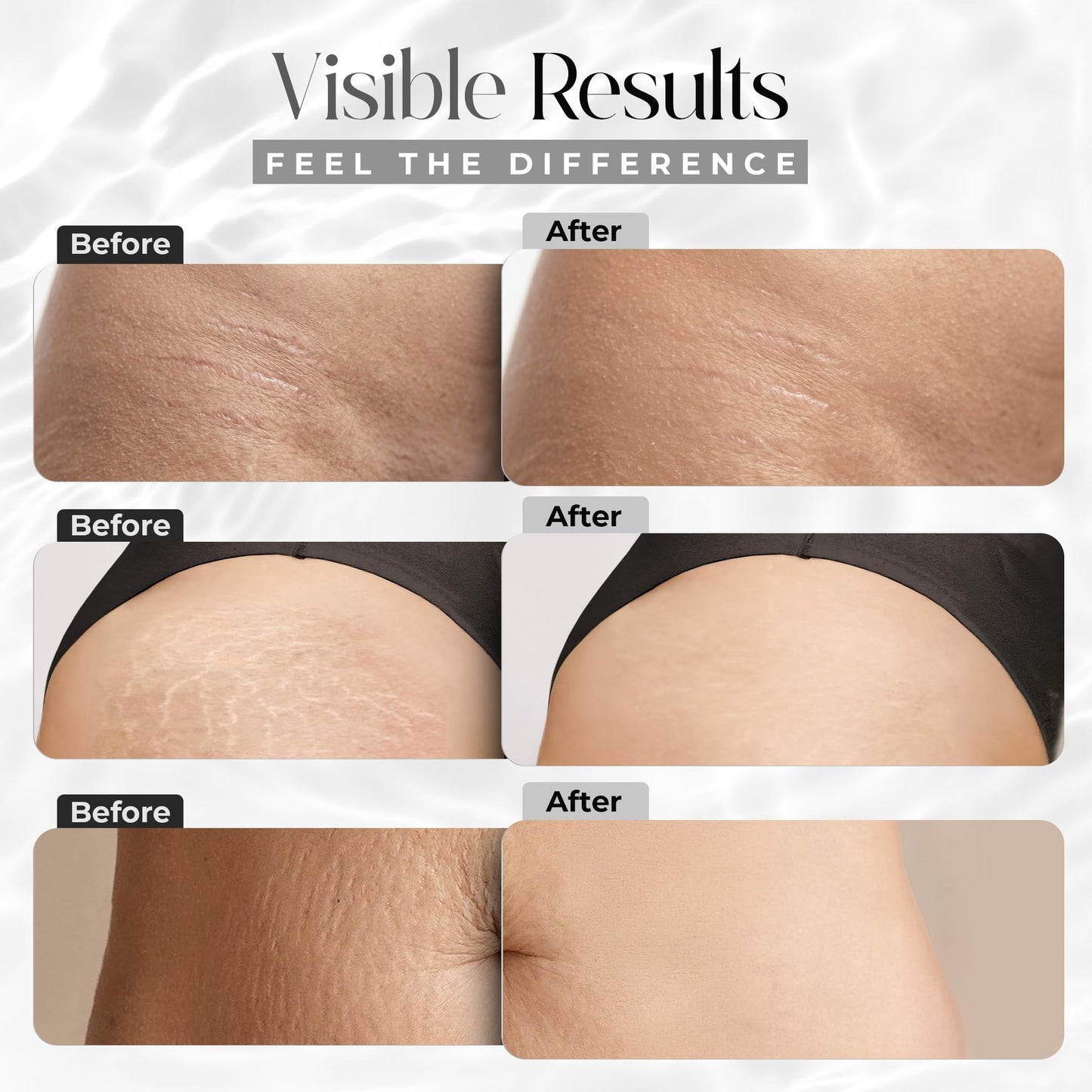 StretchMarkers Therapy Stretch Mark Cream – Visibly Reduces and Treats, Stretch Marks Removal with Retinol, Hyaluronic Acid, Bioactive Peptides & 3D Stem Cell Technology, 1 fl oz