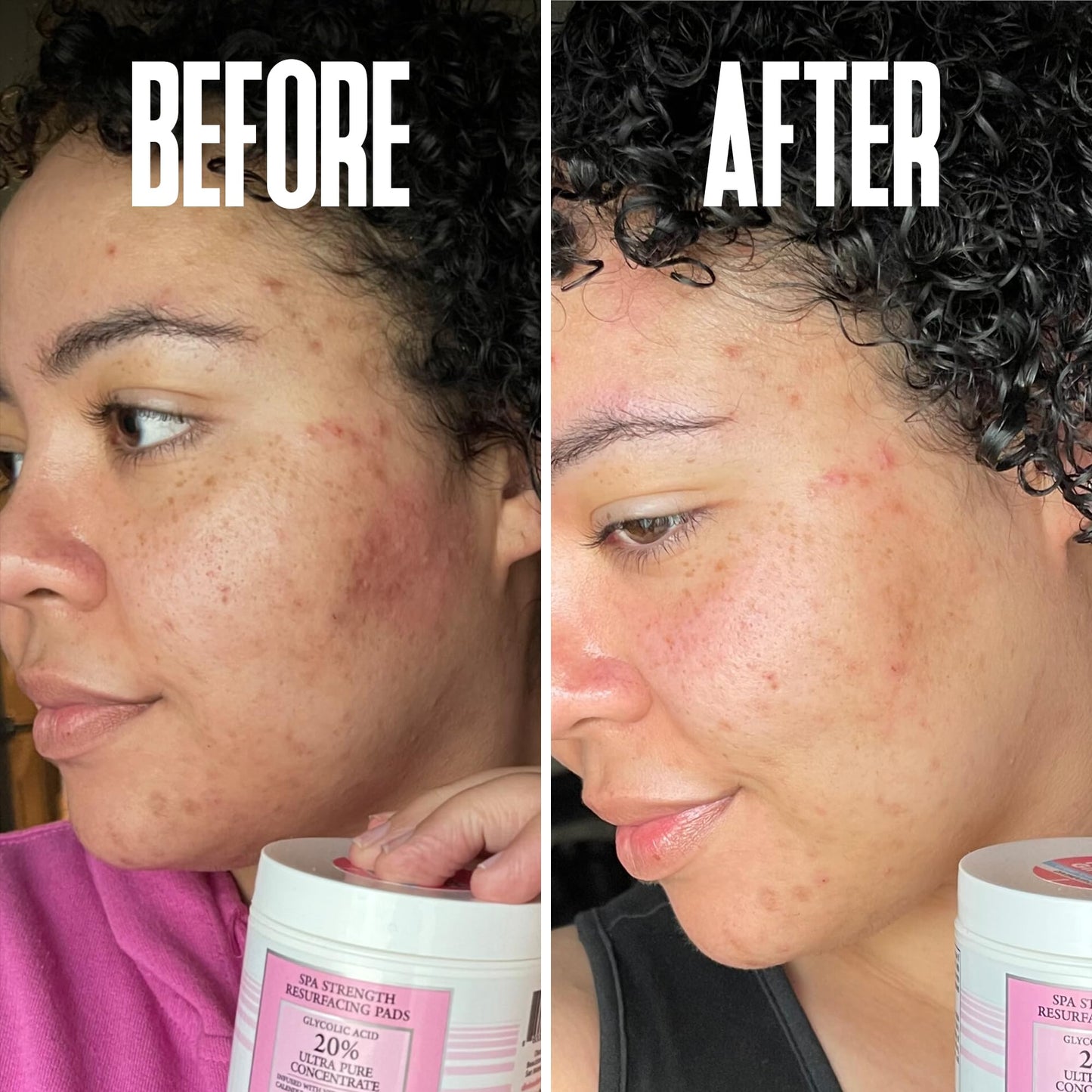 Anti Aging Skin Care Set: Glycolic Acid Peel 60% & Glycolic Resurfacing Pads - This Ultra Potent Duo Will Purify Your Skin & Eliminate Wrinkles, Acne Scarring For an Ultra Clear & Glowing Complexion