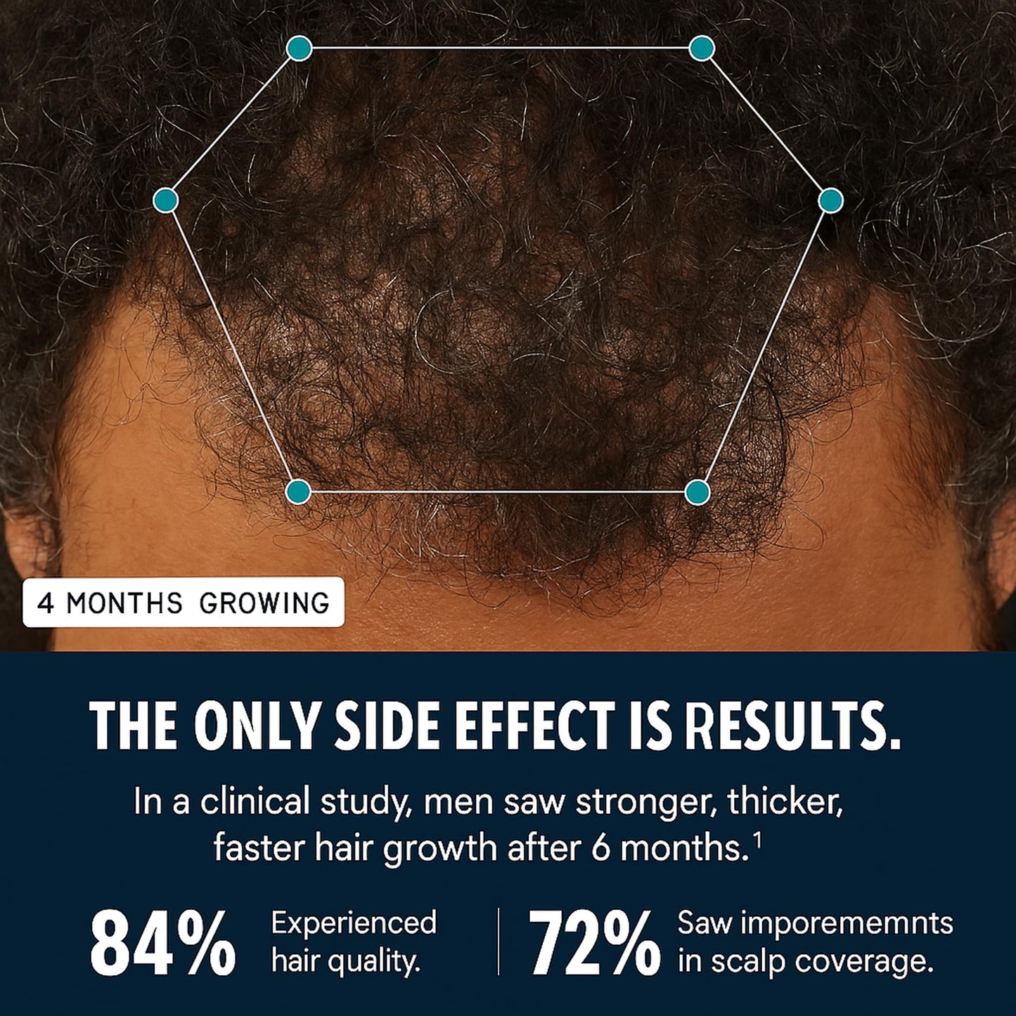 Hairfol Men's Hair Growth Supplement – Clinically Tested Hair Growth Vitamins for Men, Thicker Hair & Scalp Coverage, Hair Regrowth Support for Men – Stronger, Fuller Hair – 1 Month Supply