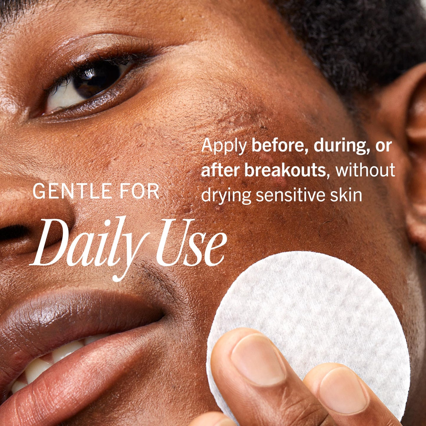 First Aid Beauty Acne Treatment Pads, 2% Salicylic Acid Maximum Strength Acne Pads for Face, Non-Drying Formula, Sensitive Skin, 60 ct