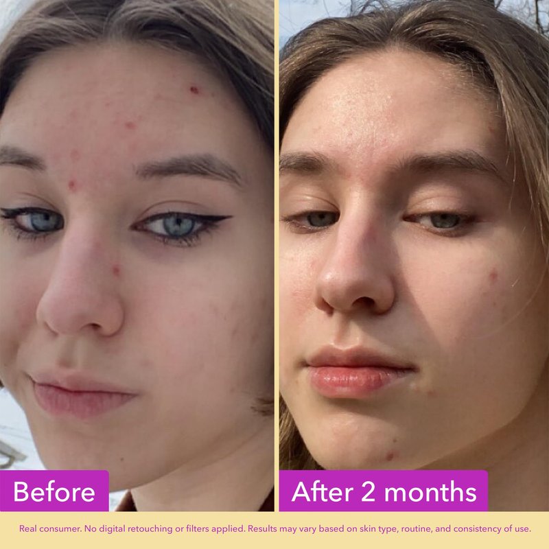 Good Molecules Niacinamide Serum - 10% Niacinamide to Target Blemishes, Nourishment, and Skin Tone - Ultra Hydrating Serum and Brightening Skin Care for Face