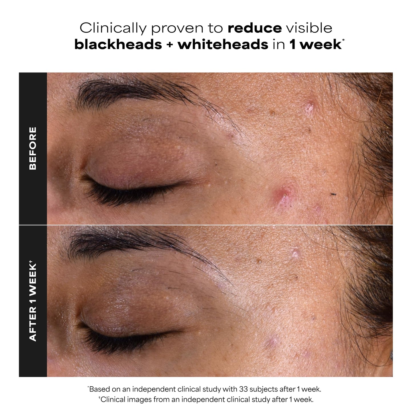 Paula's Choice SKIN PERFECTING 2% BHA Salicylic Acid Exfoliating Pads - Facial Exfoliant Pads for Blackheads, Enlarged Pores, Wrinkles & Fine Lines