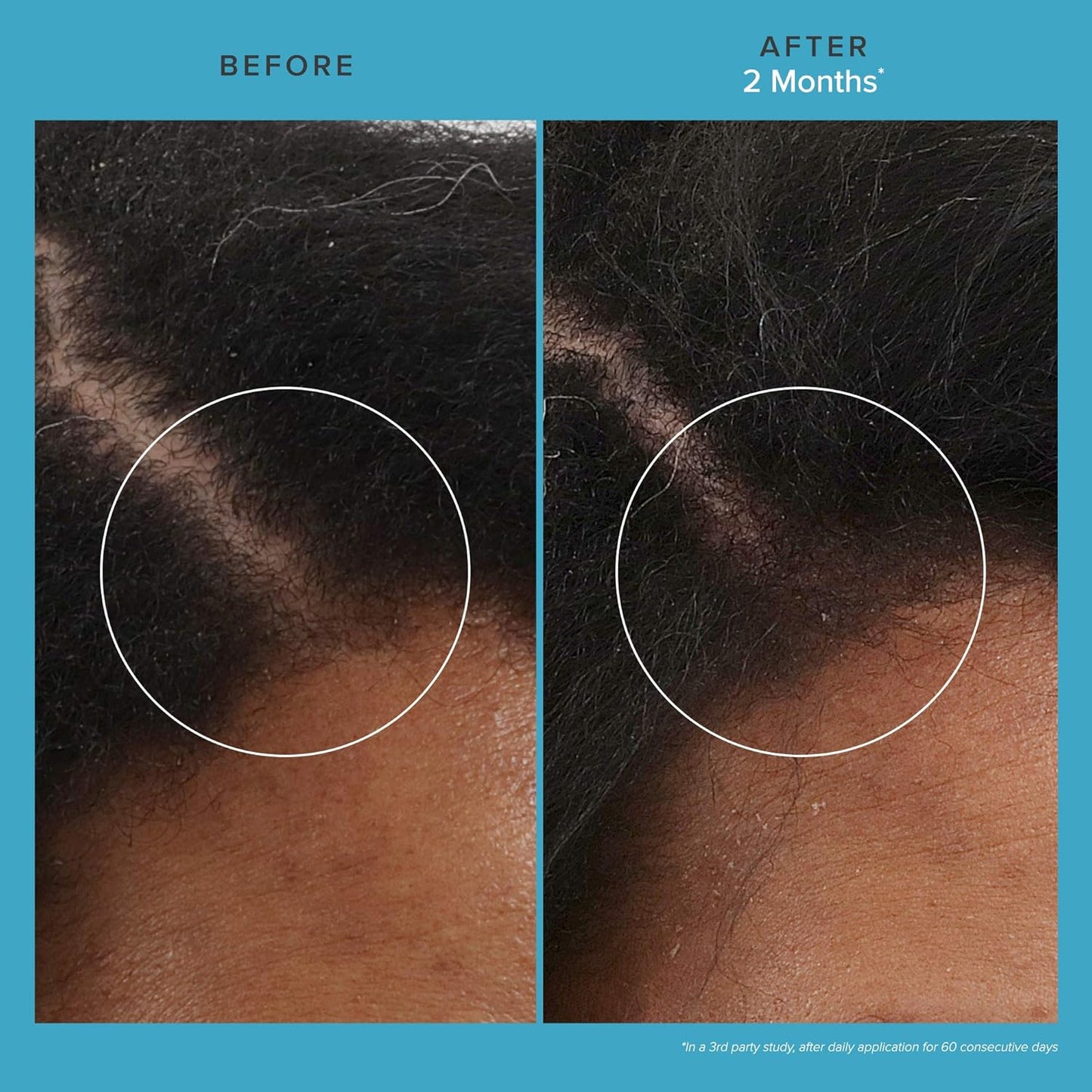 Living Proof Scalp Care Revitalizing Hair Treatment - Thicker, Fuller Hair, 2.5 Fl Oz