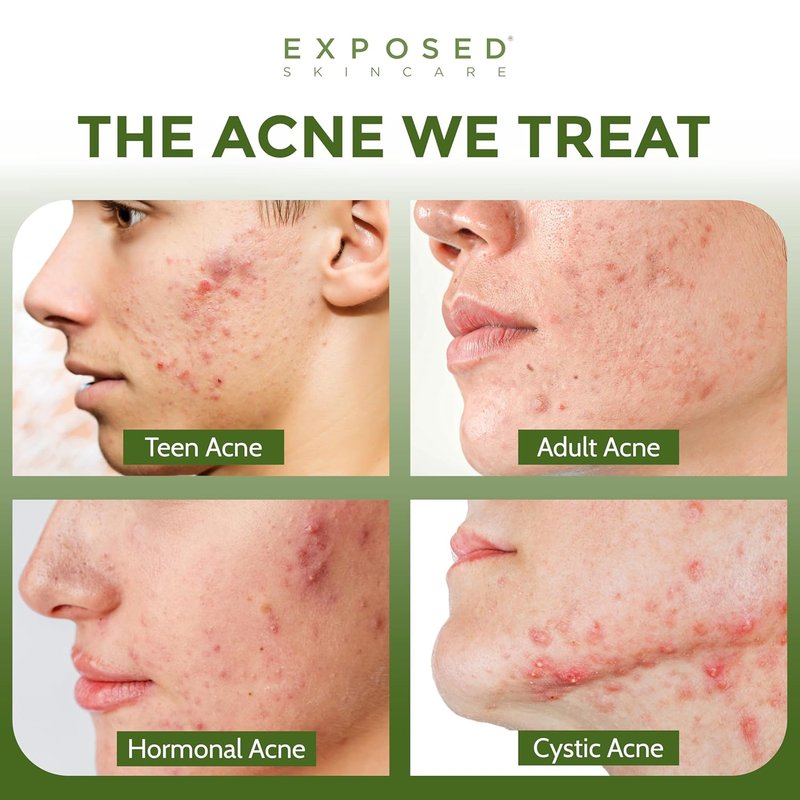 Clearing Tonic Facial Toner - 1% Salicylic Acid & Witch Hazel for Acne | Natural & Non-Toxic