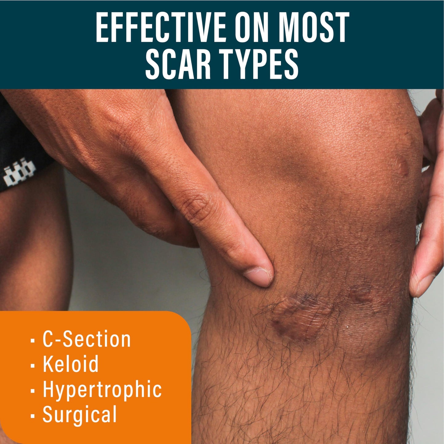 NUVADERMIS Silicone Scar Sheets & Scar Cream Gel - C-Section, Tummy Tuck, Keloid, Acne Removal Treatment - Advanced Post Surgery Supplies - Scars Removal Treatment
