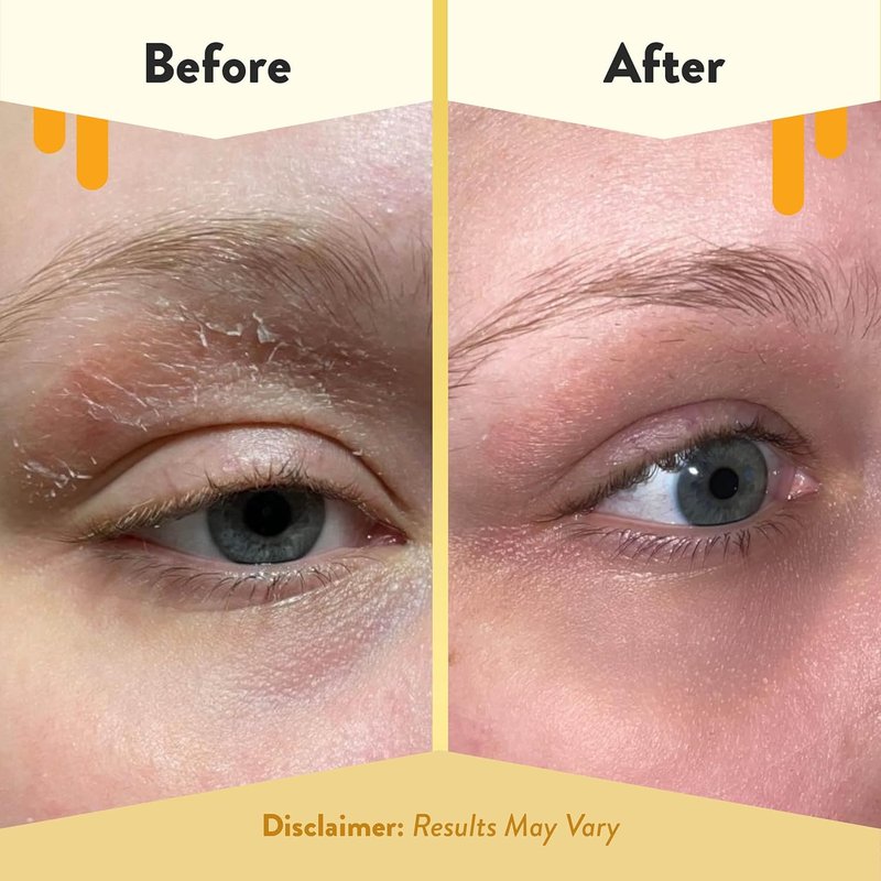 Eczema Honey Multi Peptide Eye Cream - Anti-Aging Treatment for Dark Circles & Puffiness | 0.5 Oz