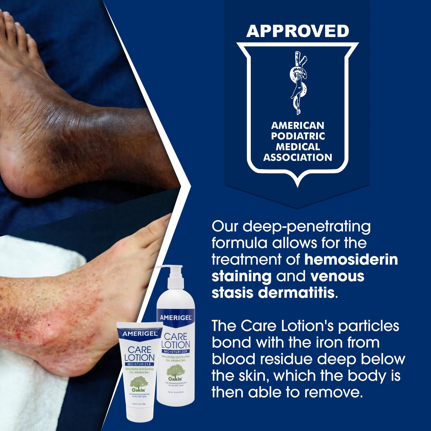 AMERIGEL Care Lotion – Hypoallergenic Moisturizer - Diabetic Skin Care - Rehydrates and Soothes Dry, Irritated Skin - 6 oz.