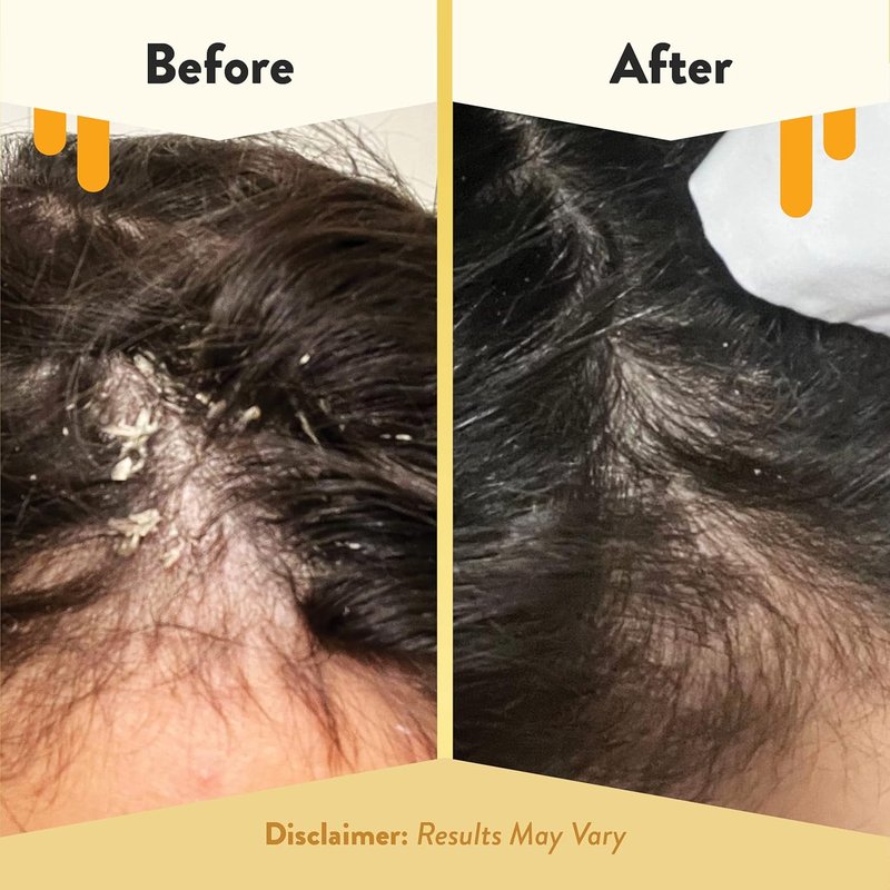 Eczema Honey Soothing Scalp & Hair Oil - Natural Relief Serum for Dry Itchy Scalp | 1 Oz Treatment for Psoriasis & Dandruff