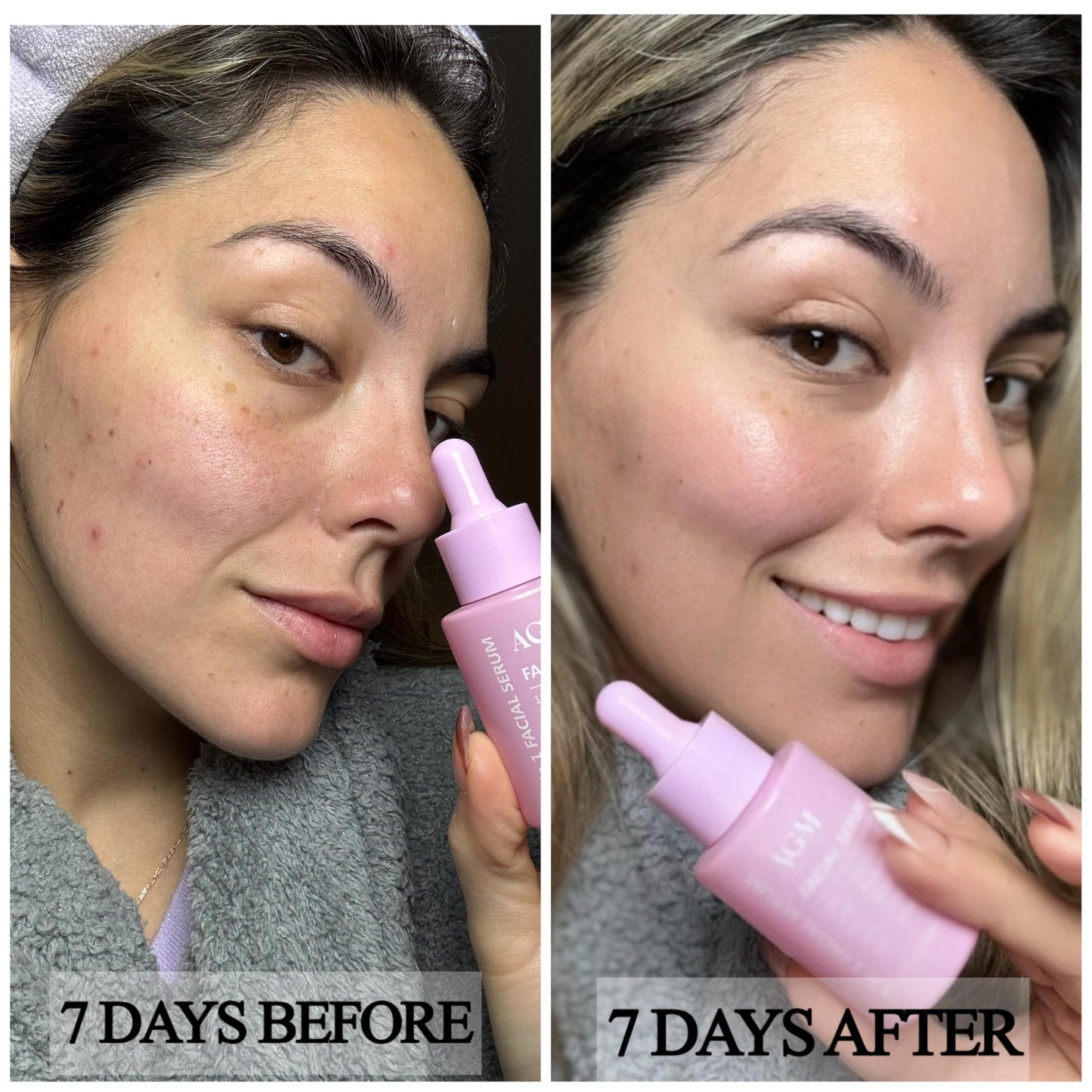 SERUM FACIAL 5 EN 1 - GLUTATIÓN,ÁCIDO HIALURÓNICO, VITAMINA C, VITAMINA E Y NIACINAMIDA - ANTIMANCHAS E HIDRATANTE, ANTIEDAD, ILUMINADOR, ANTIACNÉ, CONTROLADOR DE GRASA Y REAFIRMANTE - 30 ML