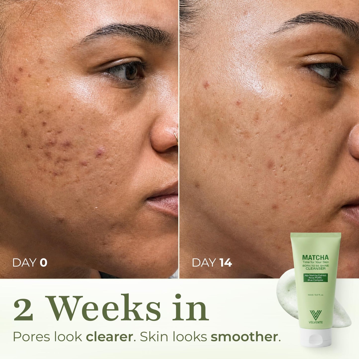 VELVENTE Matcha PDRN Korean Cleanser & Face Wash, Acne-Prone Sensitive Skin