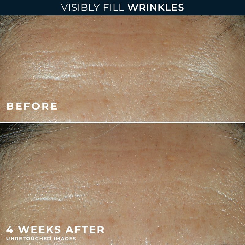 RoC Retinol Correxion Wrinkle Filler for Deep Wrinkles with Hyaluronic Acid & Retinol, Skin Care for Women and Men, 1 Fl Oz (Packaging May Vary)