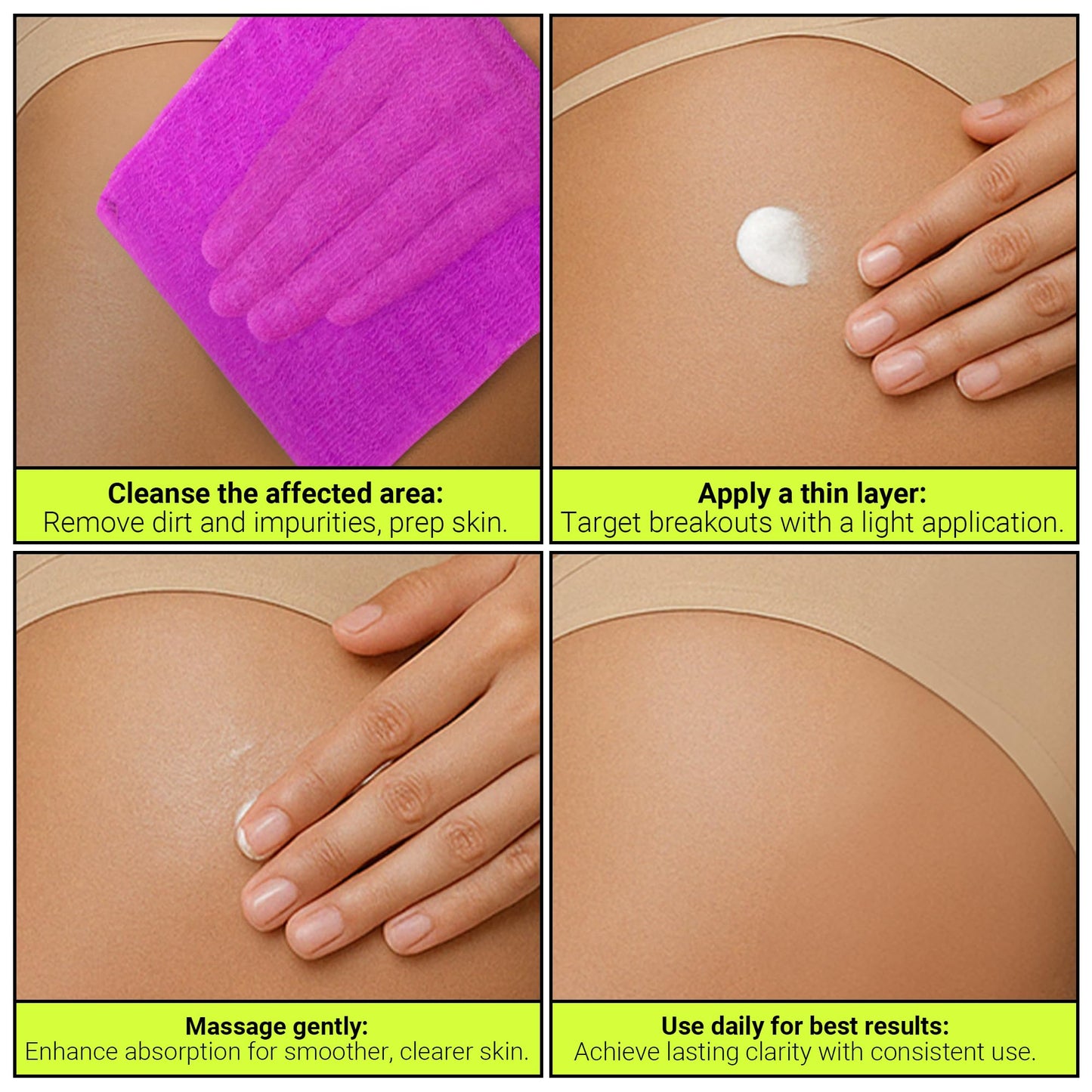 SKINBOSS 5oz Butt Acne Clearing Treatment - Body Acne Lotion for Pimples on Buttocks, Thighs, & Body, Targets Folliculitis, Scars, & Dark Spots, Hydrating Anti-Blemish Body & Self-Care Butt Cream