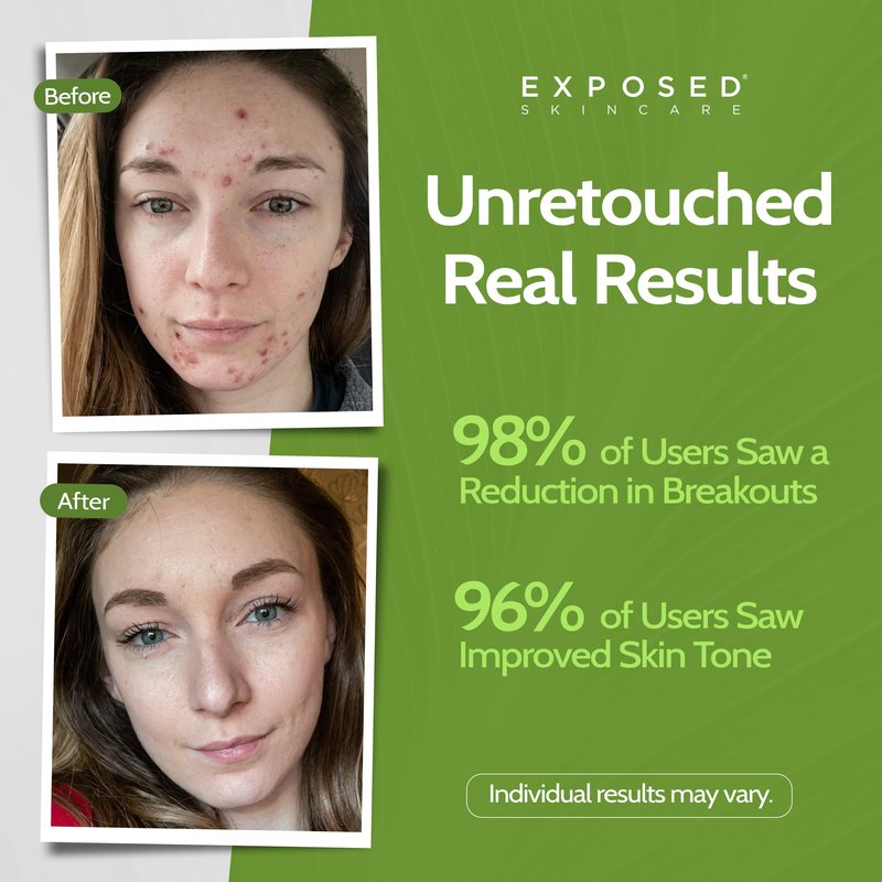 Exposed Skin Care, Moisture Complex Oil-Free Daily Face Moisturizer For Women and Men – Non-Comedogenic Lightweight Hydrating Gel with Green Tea, Pumpkin Seed and Caffeine for Oily, Acne-Prone Skin