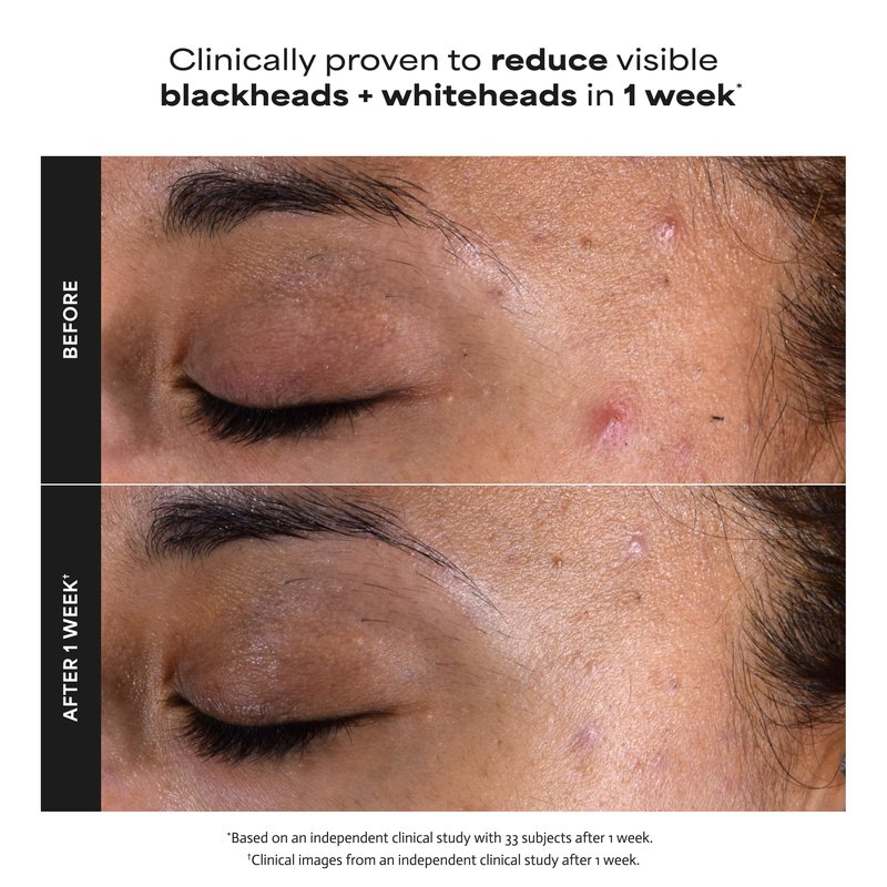 Paulas Choice--SKIN PERFECTING 2% BHA Liquid Salicylic Acid Exfoliant--Facial Exfoliant for Blackheads, Enlarged Pores, Wrinkles & Fine Lines, 4 oz Bottle