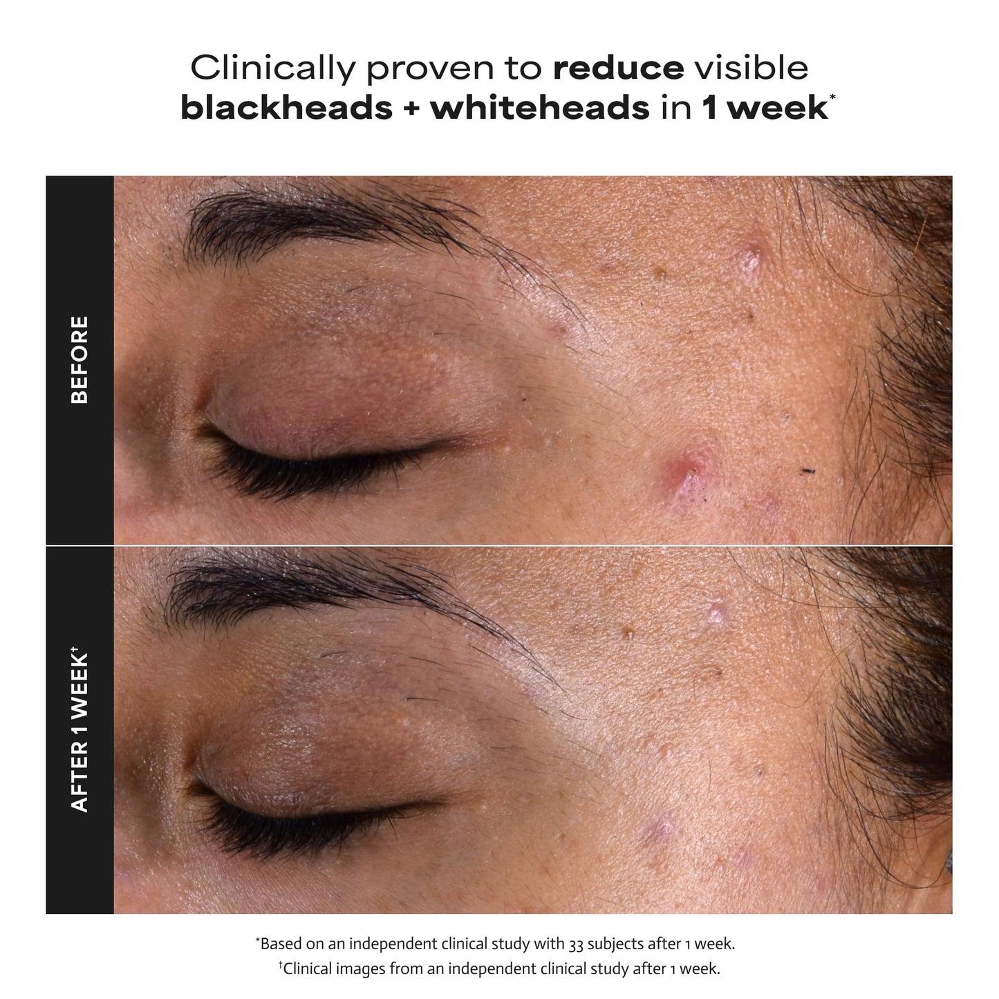 Paula's Choice Skin Perfecting 2% BHA Liquid Salicylic Acid Exfoliant, Gentle Facial Exfoliator for Blackheads, Large Pores, Wrinkles & Fine Lines, Travel Size, 1 Fluid Ounce