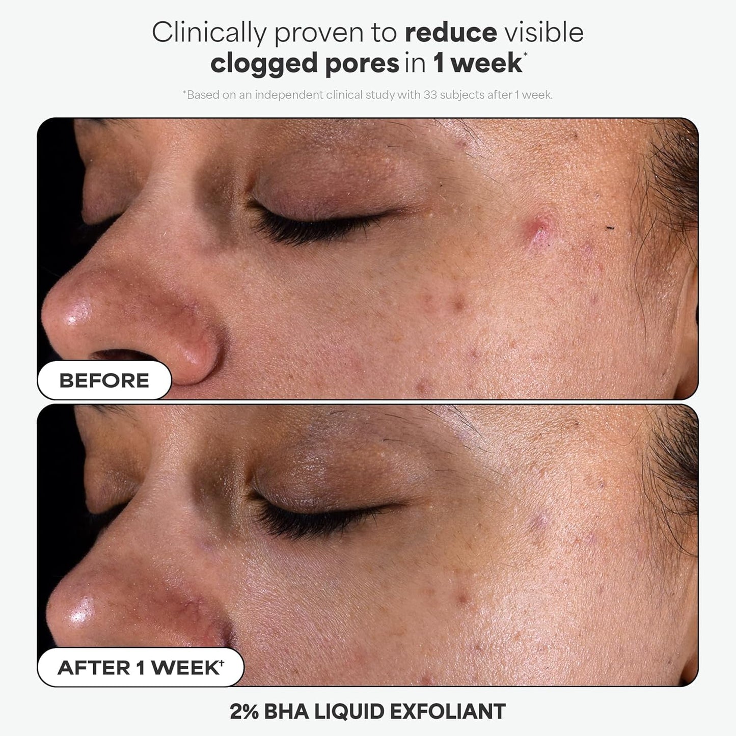 Paula's Choice Complexion Clarity Kit - 2% BHA Exfoliant & 1% Retinol Treatment | 3-Piece Skin Care Set for Clear, Glowing Skin