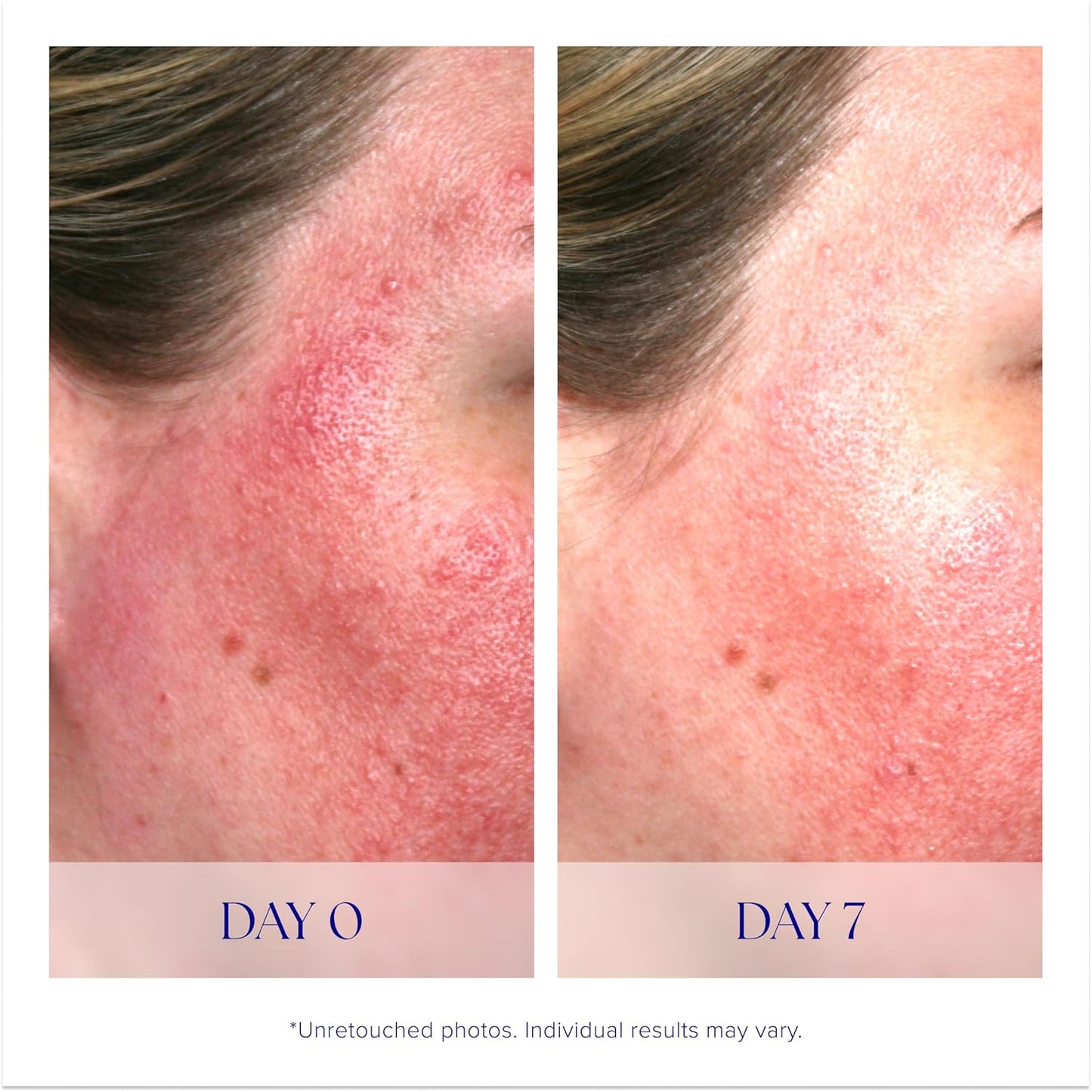 iS CLINICAL Pro-Heal Serum Advance+ | Antioxidant Vitamin C Serum for Redness Relief & Anti-Aging
