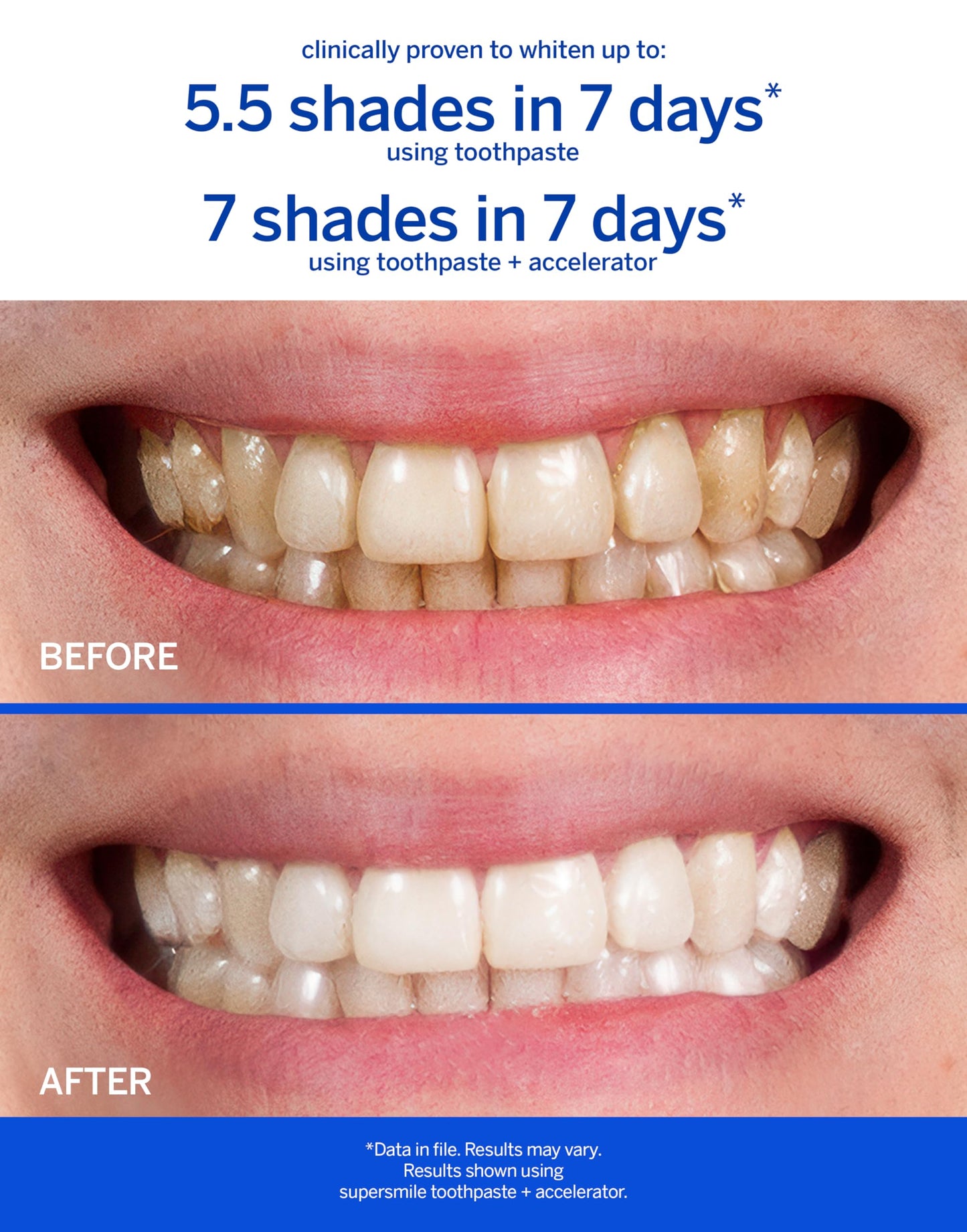 Supersmile Professional Whitening Accelerator - Powerful Whitening without Sensitivity - Safe and Effective on Dental Restorations (3.6 Oz)