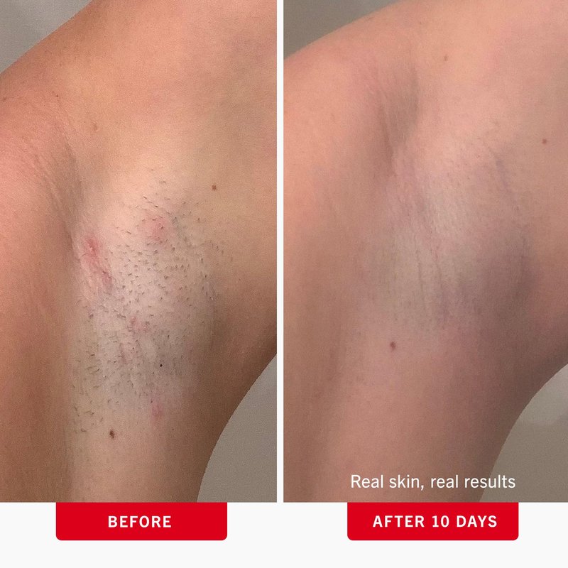 First Aid Beauty - Ingrown Hair Pads with BHA + AHA - Aftershave Treatment Pads to Help Prevent Razor Bumps for Men & Women - Exfoliate Underarms & Bikini Area - Compostable for Daily Use - 28 Pads
