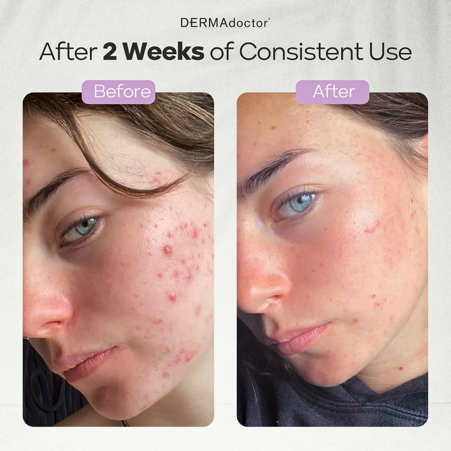 DERMAdoctor Ain't Misbehavin' Medicated Acne Face Cleanser 2% Salicylic Acid | Dermatologist Formulated to be Non-Irritating to the Skin - 7.10 oz