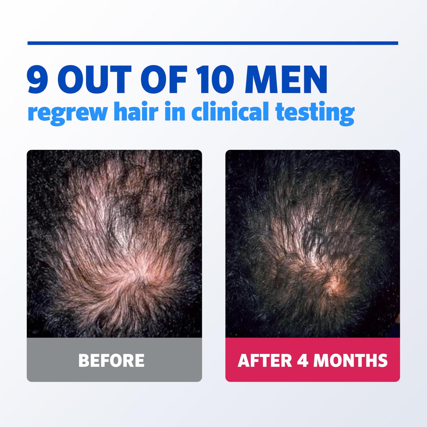 Men's Rogaine 5% Minoxidil Foam for Hair Regrowth, Topical Hair Loss Treatment for Men to Regrow Fuller, Thicker Hair, Unscented Minoxidil Topical Aerosol, 1-Month Supply, 2.11 oz