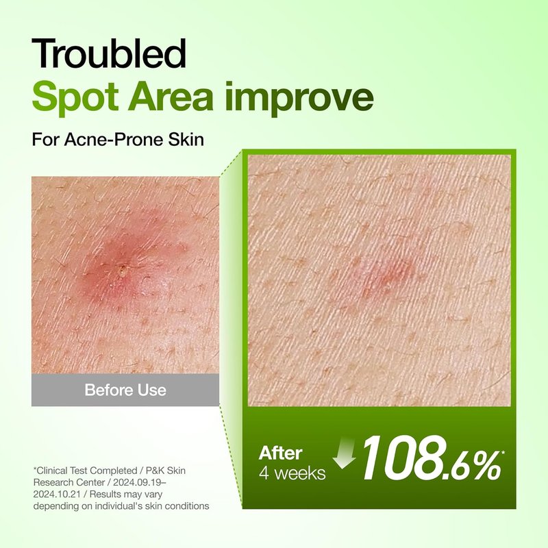 Anua Azelaic Acid Serum - Soothing Hydrating Facial Serum for Blemish-Prone Skin | 1.01 fl oz