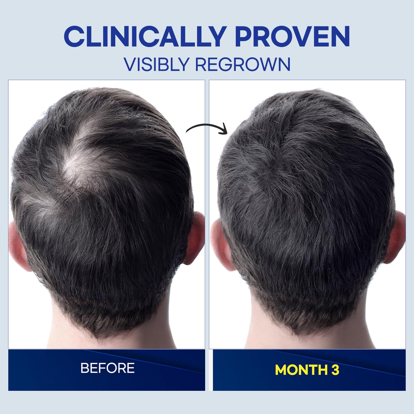 Minoxidil Hair Growth Treatment Spray: Clinically Proven 5% Minoxidil Treatment for Hair Loss & Thinning - Made in USA (2 Fl Oz (Pack of 2))