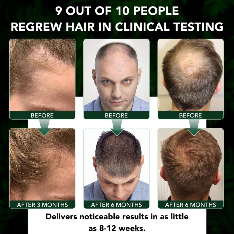 Minoxidil Spray Kit for Men and Women 5% Minoxidil Hair & Beard Growth Oil Kit, Advanced Hair Regrowth Serum Topical Solution Minoxidil Spray Treatment for Hair Loss, Thinning, Hair Thicker 2.02 fl.oz