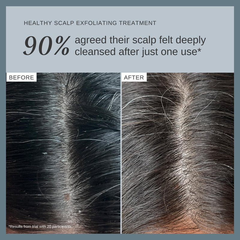 Alpha-H Healthy Scalp Exfoliating Treatment 100ml – Pre-Wash Salicylic Acid Scalp Exfoliant for Flakes, Oil & Product Buildup – Shine & Volume Boost