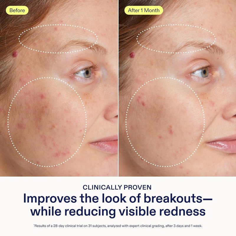 Skinfix Adapinoid Gel - Retinoid Serum for Acne-Prone Skin with Niacinamide | 1 oz - Reduces Redness & Improves Breakouts