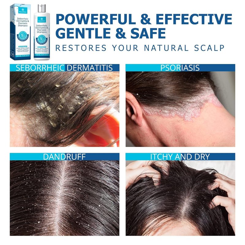 Roycederm Seborrheic Dermatitis & Psoriasis Shampoo for Dandruff - Helps Relieve Itching, Flaking & Scaling, Dry Itchy Scalp