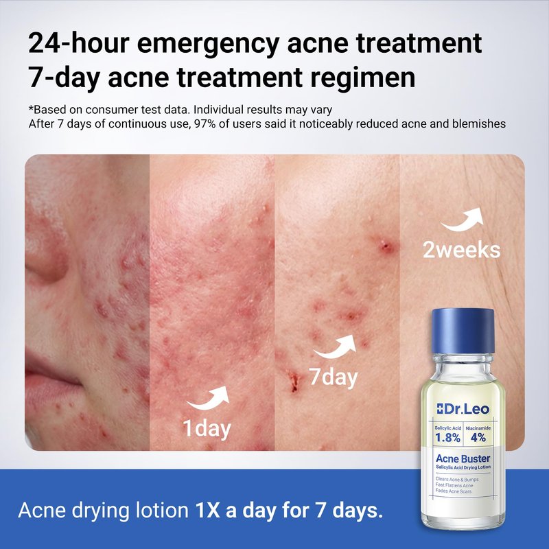Dr.Leo 1.8% Salicylic Acid Acne Treatment, Drying Lotion Acne Spot Treatment for Acne-Prone Sensitive Skin | Niacinamide, Fast Pimple Relief, Fades Acne Marks, Overnight & Period Breakouts, 0.34 fl oz