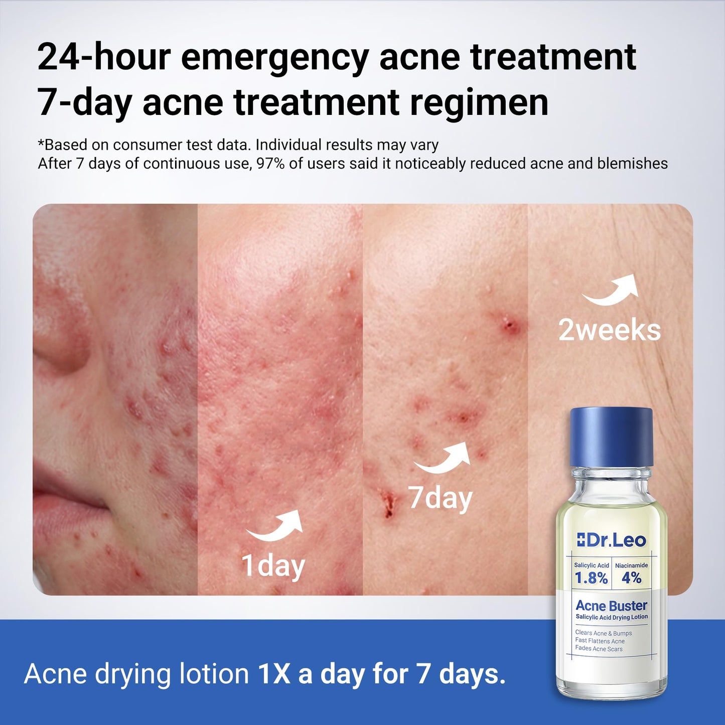 Dr.Leo 1.8% Salicylic Acid Acne Treatment, Drying Lotion Acne Spot Treatment for Acne-Prone Sensitive Skin | Niacinamide, Fast Pimple Relief, Fades Acne Marks, Overnight & Period Breakouts, 0.34 fl oz