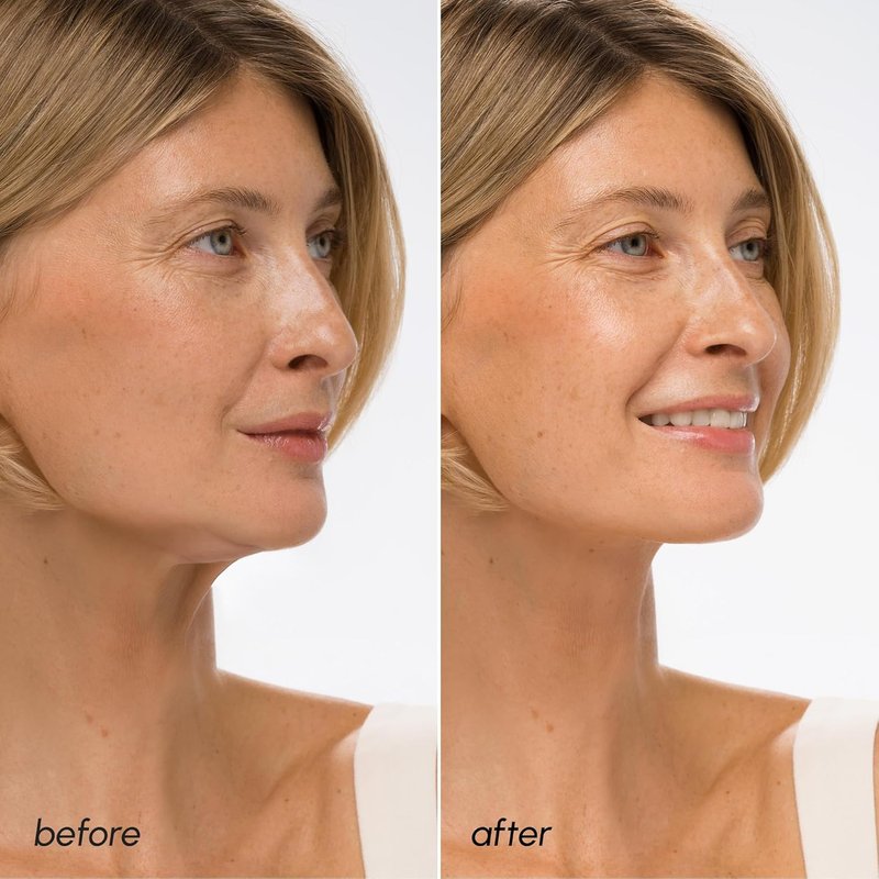V Line Lifting Mask with Hyaluronic Acid - Collagen Face Mask for Jawline Shaping & Neck Firming | Anti-Aging Retinol Treatment