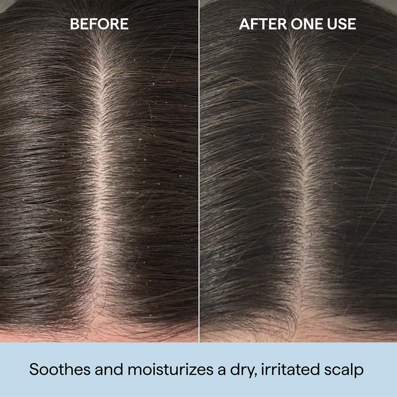 Briogeo Scalp Revival Rosemary Pre-Wash Oil | Moisturizing Scalp Treatment for Dry, Flaky, or Itchy Scalp | Strengthens Hair & Soothes Scalp | Vegan & Cruelty-Free | 3.4 oz