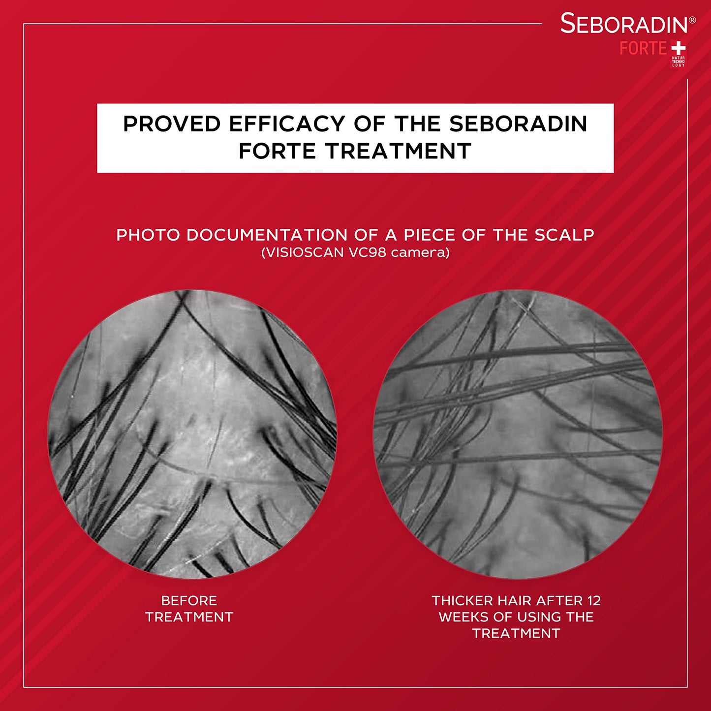 Seboradin Hair Loss And Hair Thinning Premium Lotion Treatment For Men And Women With Vitamins And Natural Extracts For Thickening And Growth Swiss Medic Technology, 200 ML