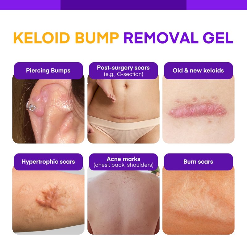 Keloid Bump Removal Gel | For Piercing Bumps, Keloids, Hypertrophic Scars & Acne Marks | With Salicylic Acid, Centella, EGF & Ceramides | Smooths, Hydrates & Supports Skin Renewal – 0.71 oz / 20g