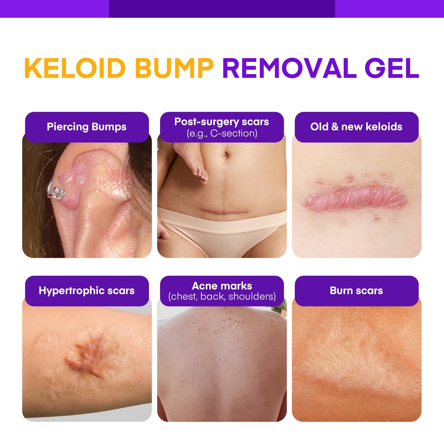 Keloid Bump Removal Gel | For Piercing Bumps, Keloids, Hypertrophic Scars & Acne Marks | With Salicylic Acid, Centella, EGF & Ceramides | Smooths, Hydrates & Supports Skin Renewal – 0.71 oz / 20g