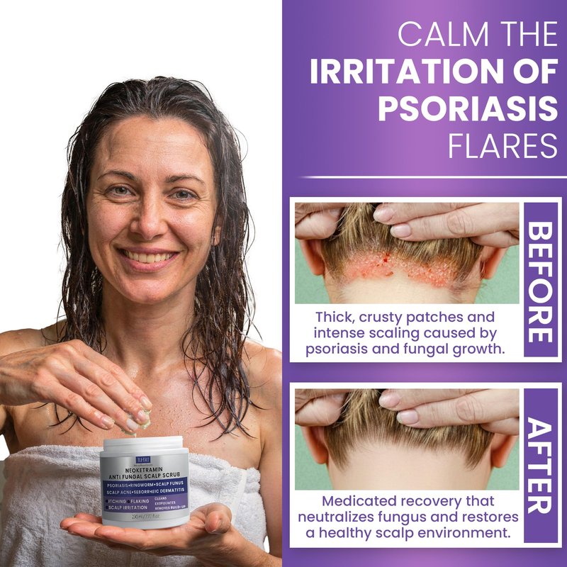 Anti Fungal Deep Conditioner for Men and Women | Scalp Treatment for Psoriasis, Dandruff, Seborrheic Dermatitis | Provides Relief from Folliculitis, Eczema, Itchy, Flaky and Dry Scalp
