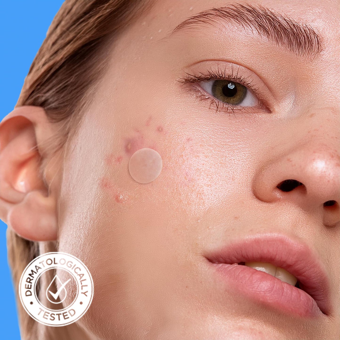AVARELLE Pimple Patches for Face | Hydrocolloid Acne Patches for Covering Blemishes | FSA HSA Store Eligible Zit Patches with Tea Tree, Calendula, & Cica | (10-14 mm, 300 Count) Bulk Pack